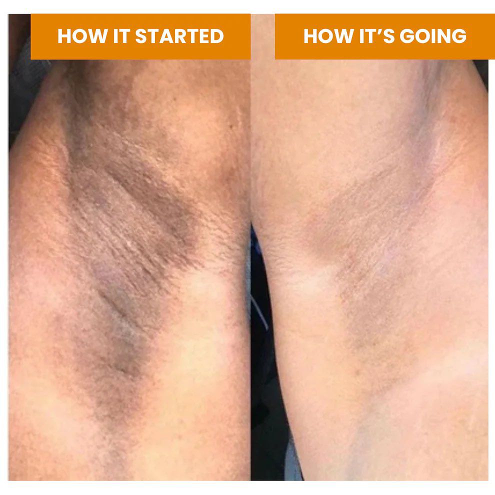 Kojic acid e Niacinamida