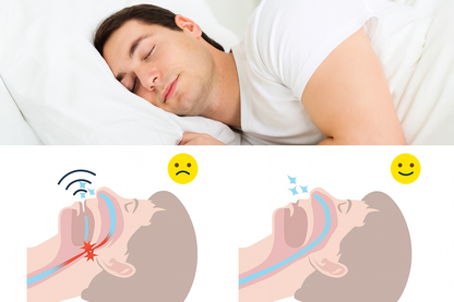SonoAlign™ Anti-ronco bucal de TPE (Material macio)