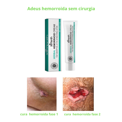 Creme para hemorroidas - EM PROMOÇÃO!