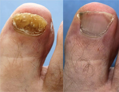 FungoClean™-Removedor de fungos nas unhas