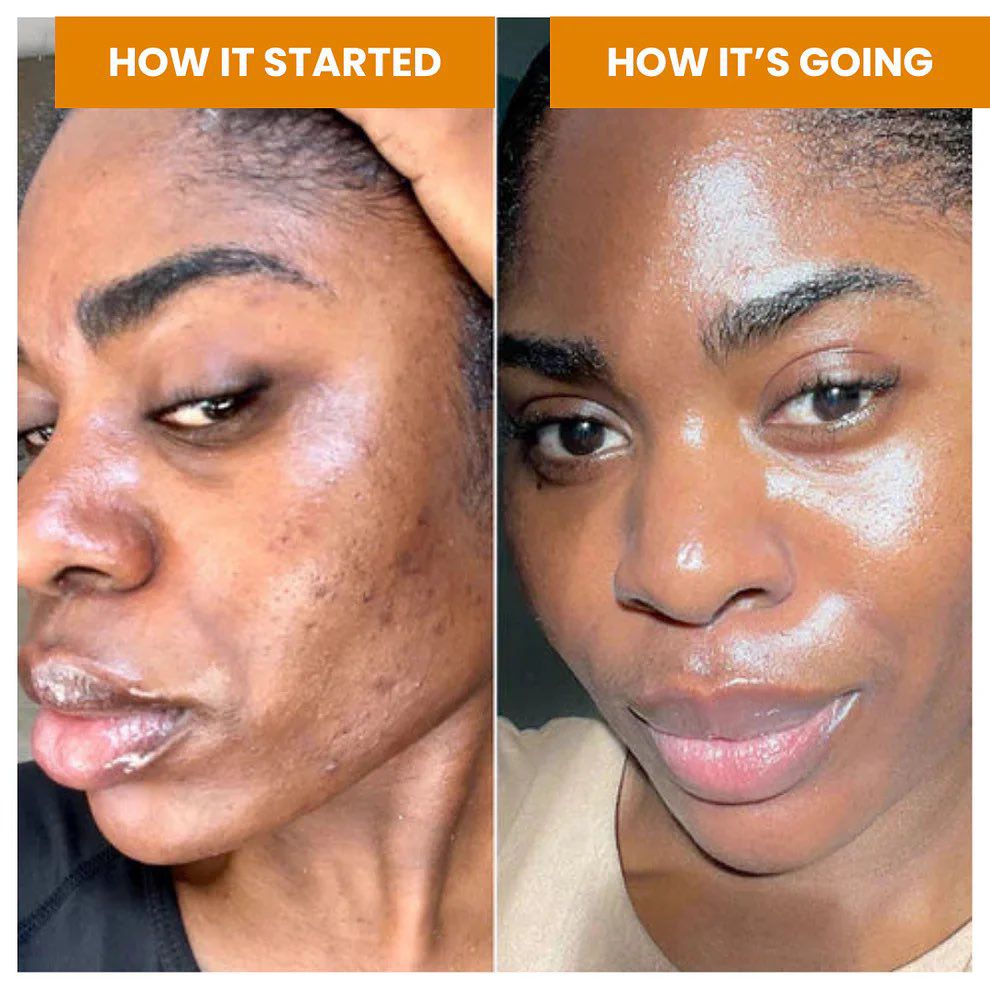 Kojic acid e Niacinamida